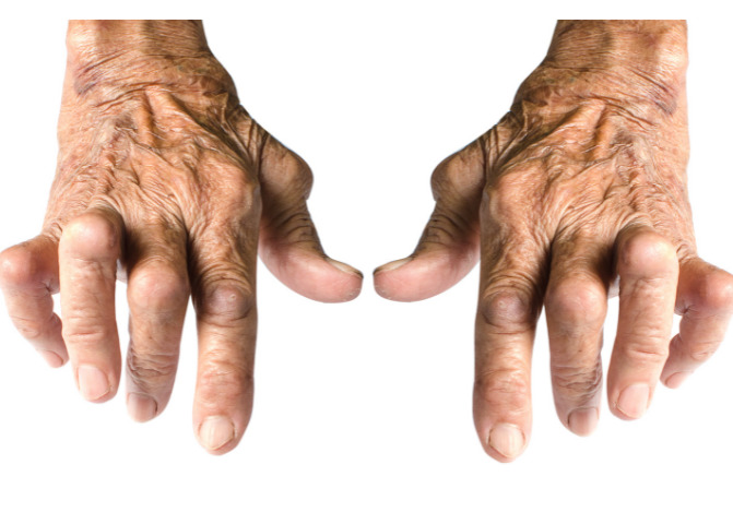 Viêm khớp dạng thấp (RA — Rheumatoid Arthritis)
