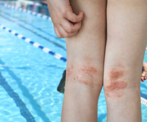 Bí quyết bơi lội an toàn cho người mắc eczema (chàm) 1 Bí quyết bơi lội an toàn cho người mắc eczema (chàm)