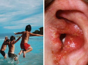 Viêm tai ngoài: Nguyên nhân, triệu chứng và cách điều trị hiệu quả