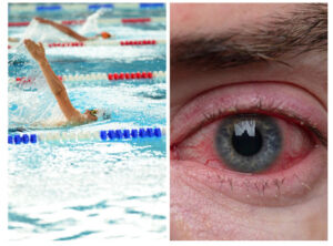 Những điều cần biết về kích ứng mắt do bơi lội 12 kich ung mat screenshot 1682296347